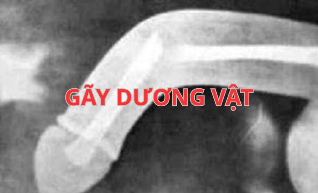 Gãy dương vật: Nguyên nhân, dấu hiệu và cách xử lý cấp cứu