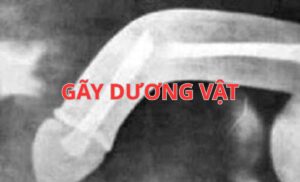 Gãy dương vật: Nguyên nhân, dấu hiệu và cách xử lý cấp cứu