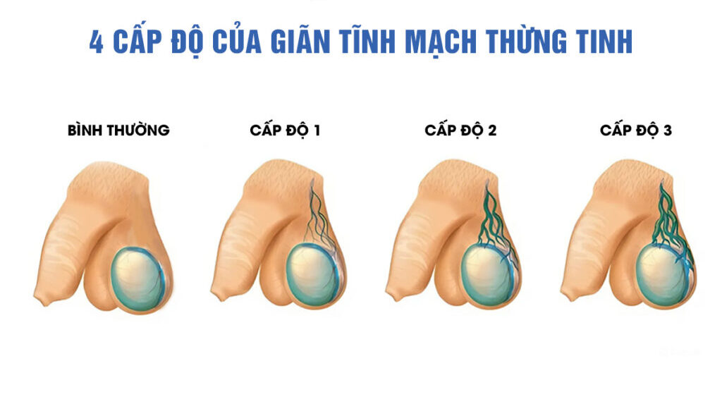 Giãn tĩnh mạch thừng tinh độ 1 chưa thể nhận thấy bằng mắt thường