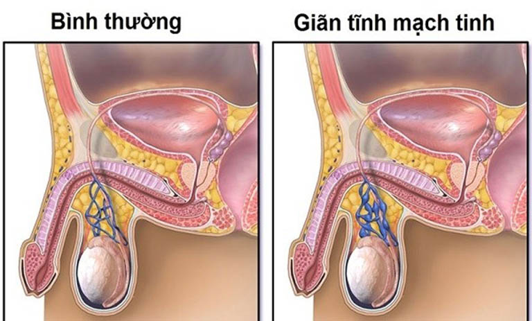 Giãn tĩnh mạch thừng tinh là dòng máu lưu thông không hiệu quả và bị ứ đọng