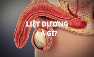 Liệt dương là gì? Nguyên nhân, dấu hiệu và cách điều trị hiệu quả