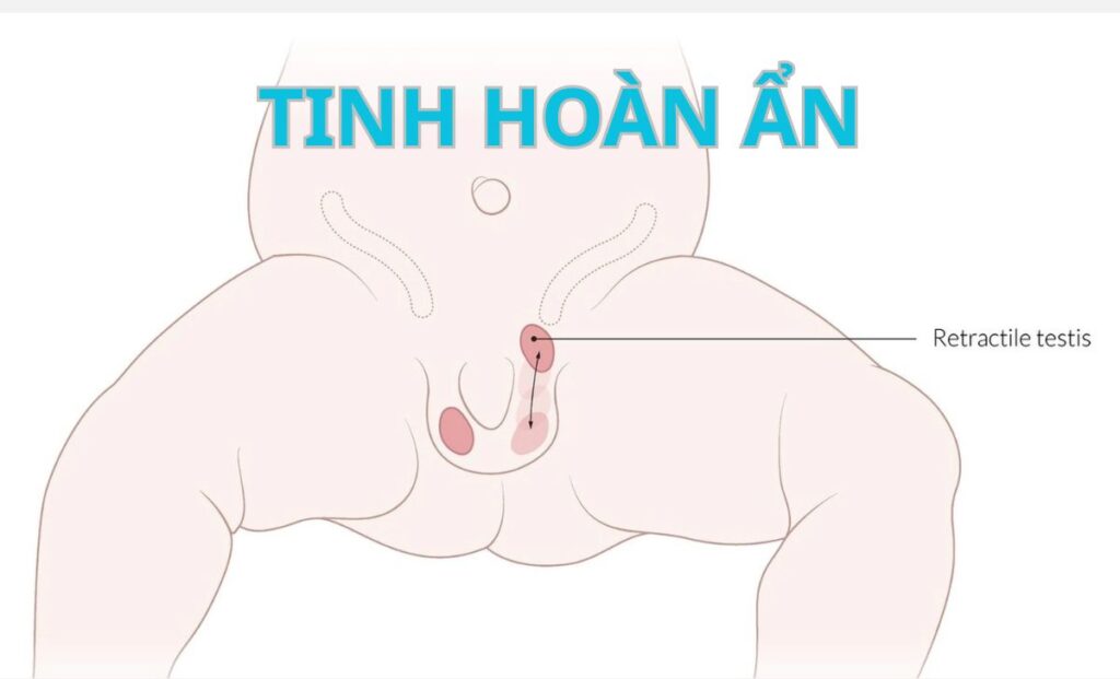 Tinh hoàn ẩn: Nguyên nhân, tác hại và phương pháp điều trị