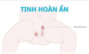 Tinh hoàn ẩn: Nguyên nhân, tác hại và phương pháp điều trị
