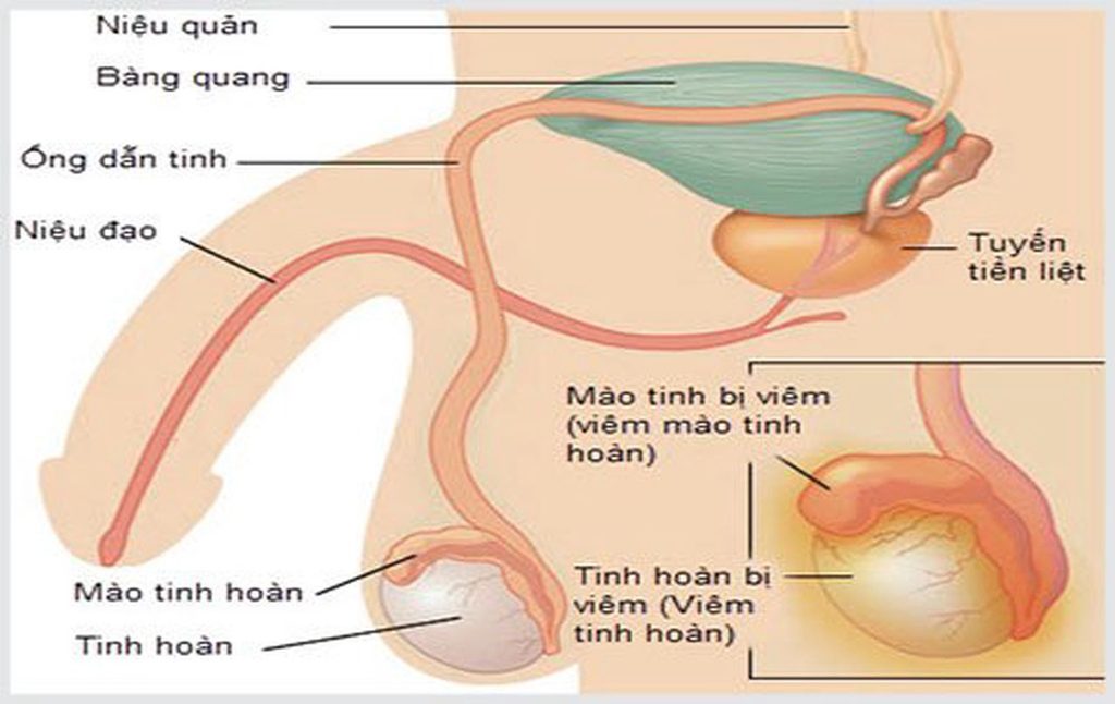 Viêm tinh hoàn là tình trạng viêm xảy ra tại một hoặc cả hai tinh hoàn