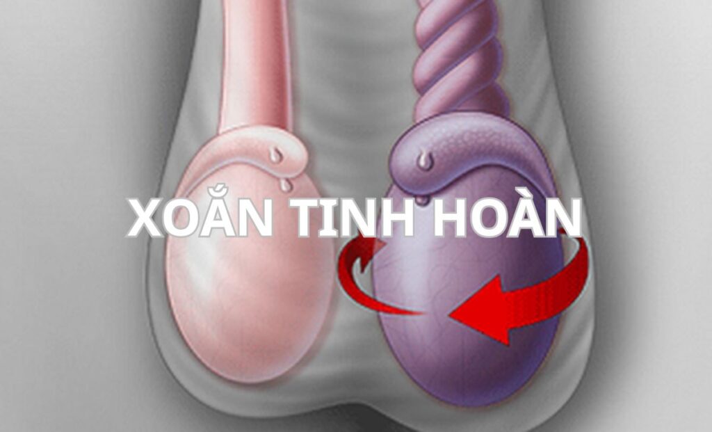 Xoắn tinh hoàn: Dấu hiệu nhận biết và cách xử lý cấp cứu