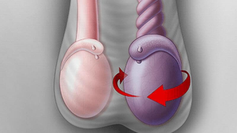 Tinh hoàn ẩn và viêm tinh hoàn là hai tình trạng khác nhau